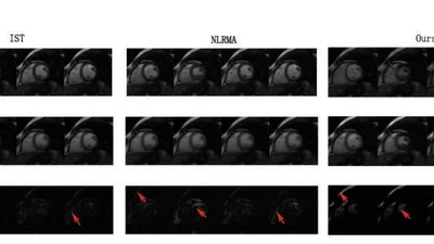 A Fast Low-Rank Matrix Factorization Method for Dynamic Magnetic Resonance Imaging Restoration featured image